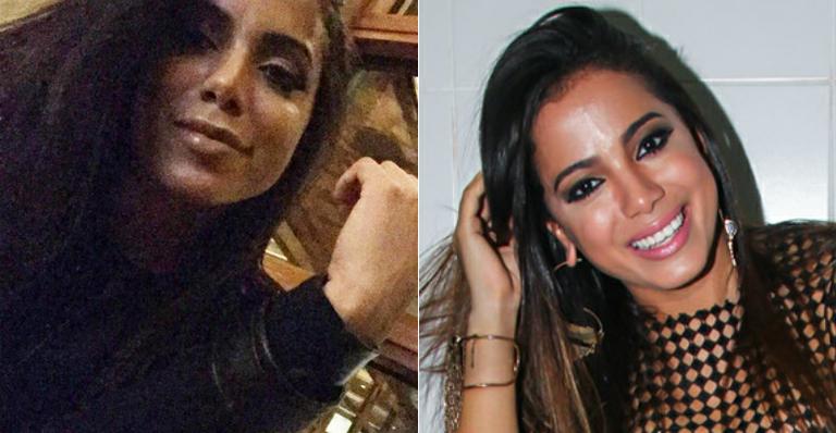 Anitta faz selfie após suposto preenchimento labial e fãs criticam: “Está parecendo o Michael Jackson”