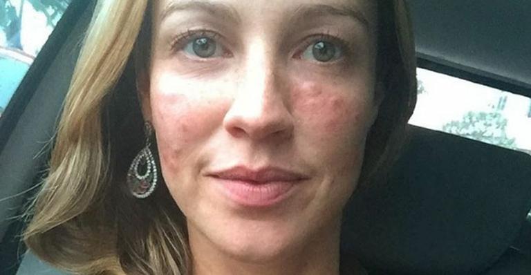 Luana Piovani aparece com o rosto inchado em foto