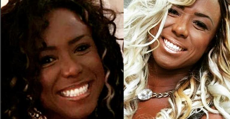 Adélia mostra antes e depois de cirurgia para diminuir a bochecha