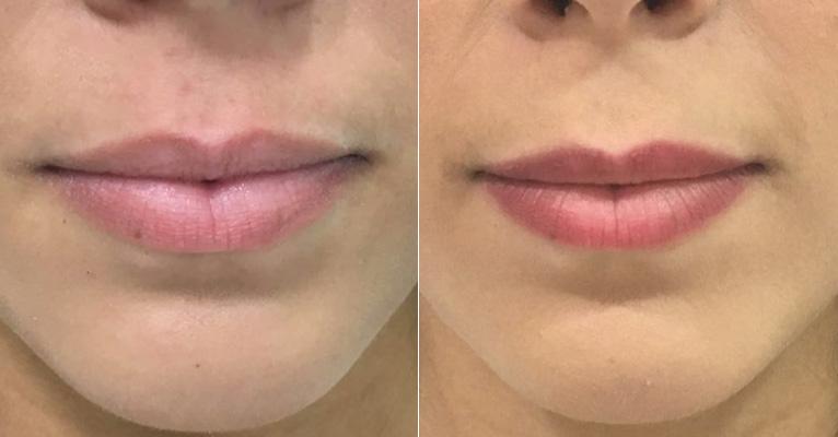 Micropigmentação dos lábios: saiba como é feito o procedimento que rejuvenesce a boca