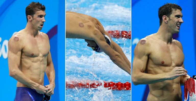 Conheça o tratamento da ventosaterapia, usado por Michael Phelps