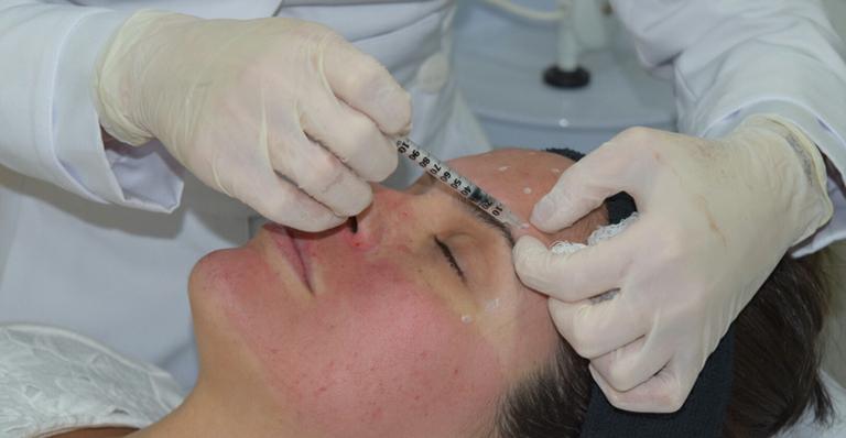 Microbotox: conheça a técnica que elimina as rugas sem alterar a contração muscular