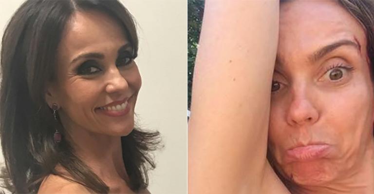 Flávia Monteiro mostra hematomas nos bastidores de seriado da TV Record