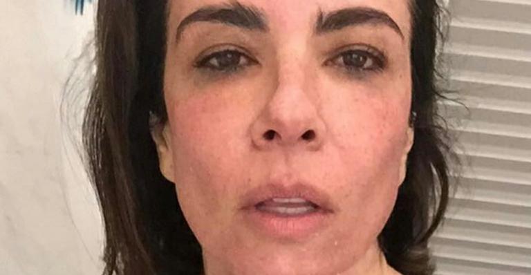 Luciana Gimenez posta foto após tratamento estético e diz: “Esfolada”