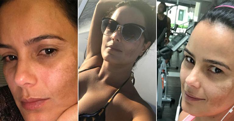 Luciele di Camargo mostra melasma no rosto; dermatologista explica o que é