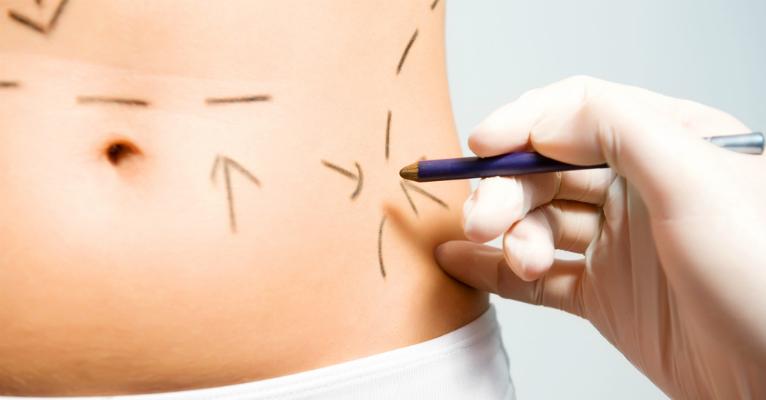 Saiba quando e como fazer exercícios físicos após uma cirurgia plástica