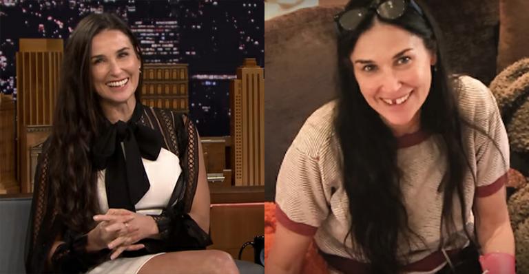 Demi Moore perdeu dentes da frente devido a estresse; dentista explica