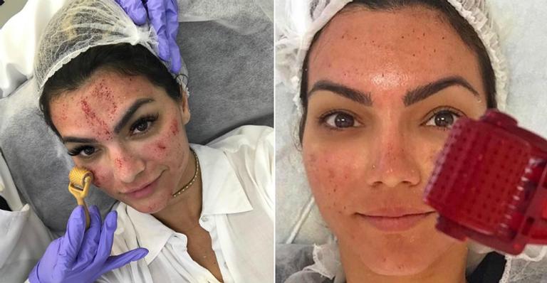 Kelly Key fala sobre tratamento para melasma; entenda procedimento