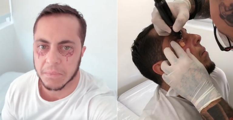 Thammy Miranda faz tatuagem para corrigir olheiras