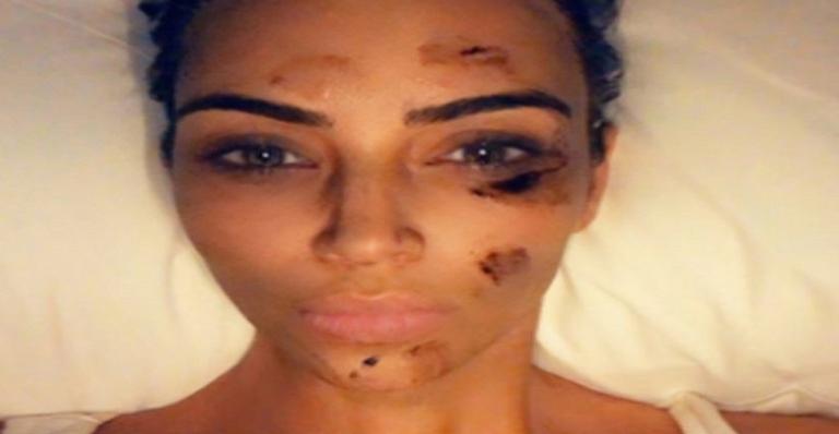 Após tentar de tudo, Kim Kardashian revela seus truques para tratar a psoríase