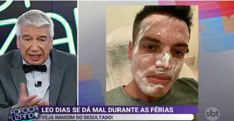 Leo Dias exagera no sol durante férias e passa apuros em Porto de Galinhas