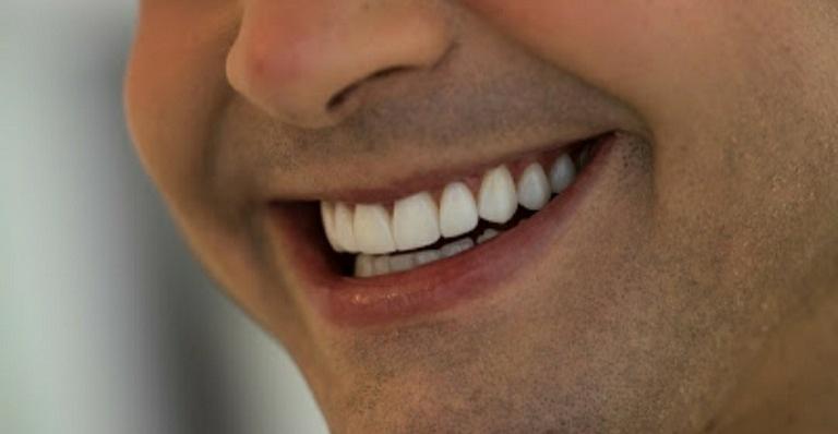 Sorrisos perfeitos sem nenhum desgaste dental